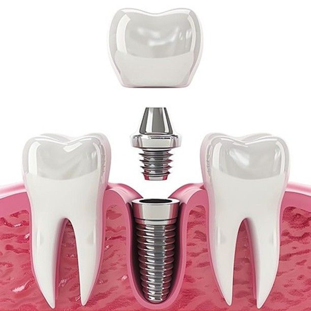 Implant planning