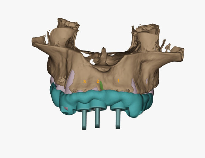 Surgical guide